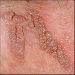hpv_vulva